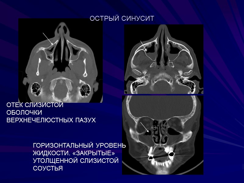 ОСТРЫЙ СИНУСИТ  ОТЕК СЛИЗИСТОЙ ОБОЛОЧКИ ВЕРХНЕЧЕЛЮСТНЫХ ПАЗУХ ГОРИЗОНТАЛЬНЫЙ УРОВЕНЬ ЖИДКОСТИ. «ЗАКРЫТЫЕ» УТОЛЩЕННОЙ СЛИЗИСТОЙ